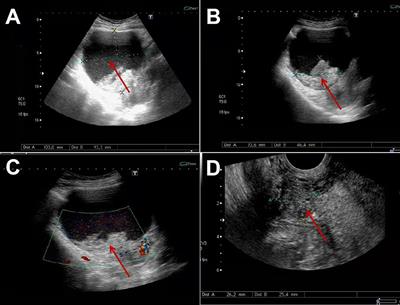 Subserous Cystic Adenomyosis: A Case Report and Review of the Literature